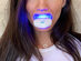 SmileME Teeth Whitening Kit