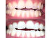 Smile Sciences Teeth Whitening Kit (Bubblegum)