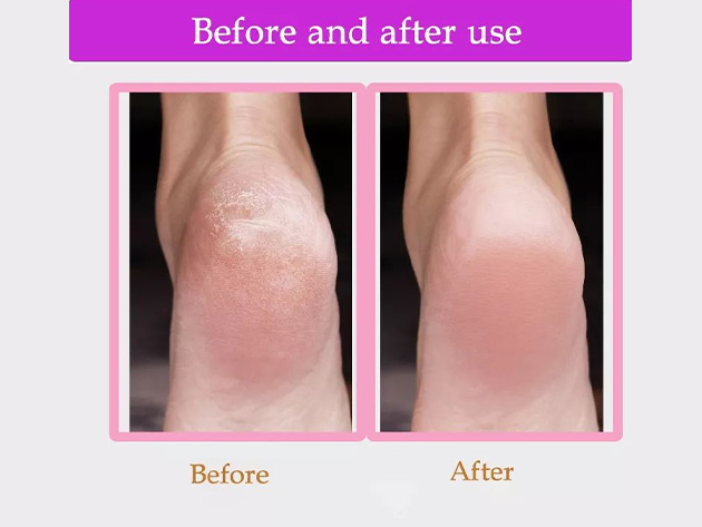 Smooth Heels Electric Callus Remover (Pink)